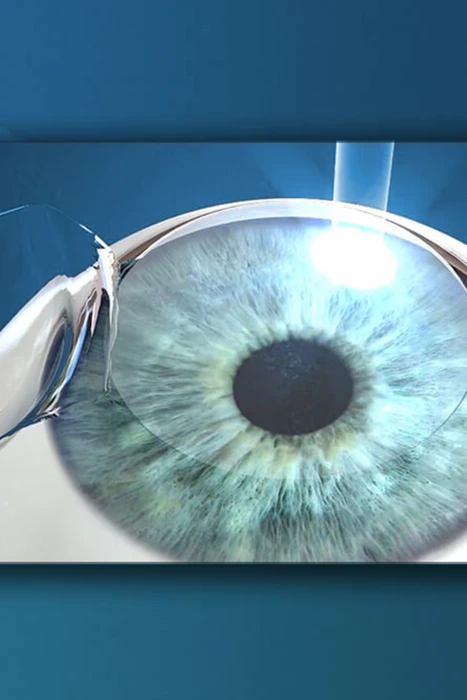 chirurgie Lasik à Casablanca intervention Lasik pour les yeux, opération de correction visuelle Lasik, procédure Lasik pour la vision, chirurgie de correction des yeux Lasik